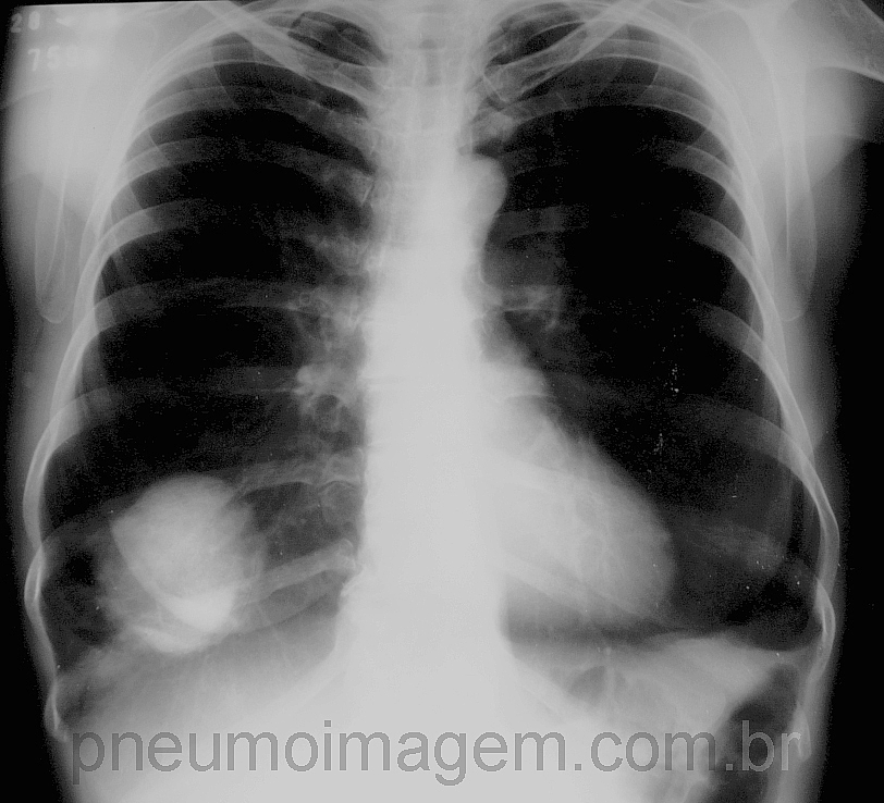 NOVAS ANOMALIAS GENÉTICAS DESCOBERTAS EM CÂNCER DE PULMÃO NOVAS ANOMALIAS GENÉTICAS DESCOBERTAS EM CÂNCER DE PULMÃO